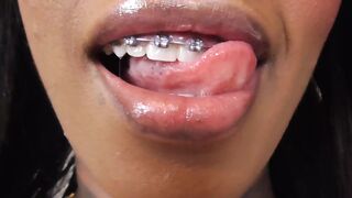 Black girl teeth brace fetish!